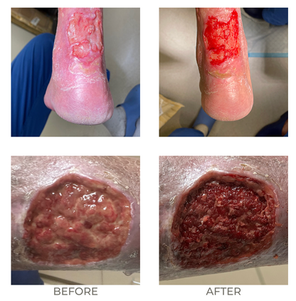 XSONX Bundle Handpiece + Disposable Heads